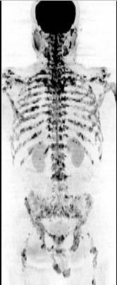 DWI Examples b-value Image Extrapolation & Inverted Grayscale Example WB-DWI patient with multiple