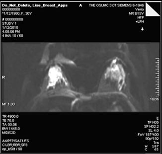 in EPI 4-years-old female patient with suspicion of Wilms tumor MIP images based on high b-value