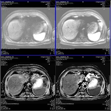 ZoomIt in Rectum Better delineation of rectal carcinoma with less distortions Emerging New Improvements in Body Diffusion (1) Motion-compensation* b=50, 6 acqs