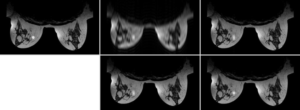 Figure 3.6: 5th frame of reconstructed image sequence. Top row (left to right): True image, zero-padded reconstruction, Keyhole reconstruction.
