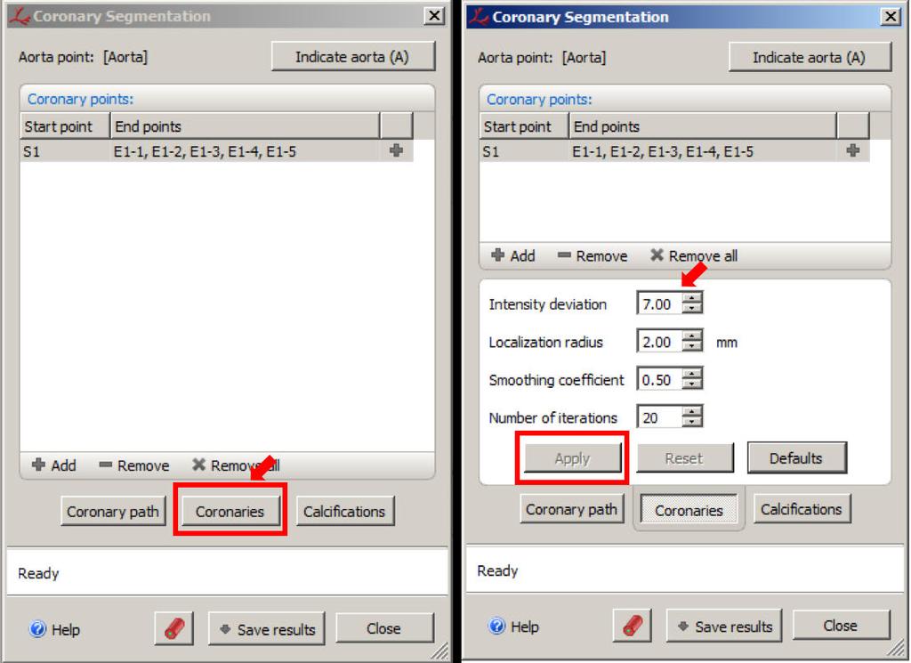 10. Click on the Coronaries button in the Coronary Segmentation tool window. Change the Intensity deviation to 7.