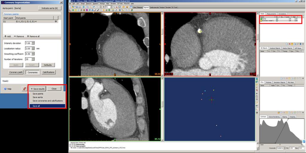 11. In the Coronary Segmentation window, click the Save results button and choose to Save all.