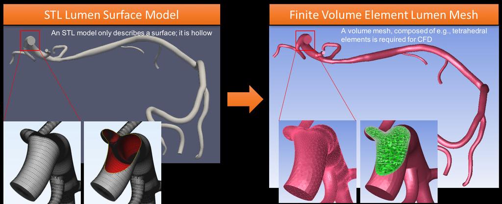 Step 2: CFD Simulation using the Segmented Coronary STL Any 3D model of the lumen that has been created and stored as an STL can be used for CFD.