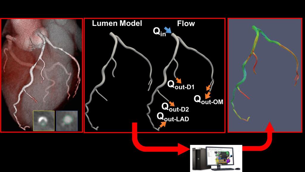 In this hands-on course we will perform a CFD simulation of blood flow in the coronary arteries starting with a patient s 3D angiography images stored in DICOM (digital imaging and communications in