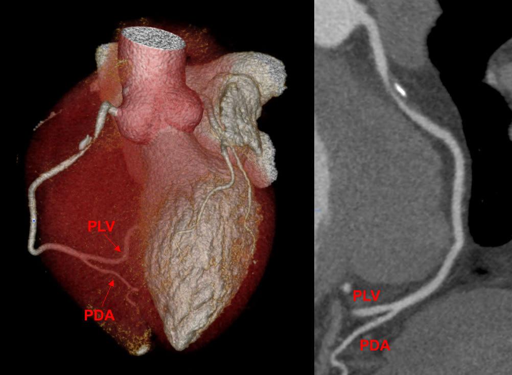 CT-FFR Case In this exercise, we will be working with the contrast-enhanced coronary CT angiogram (CTA) of a 48- year-old male patient with hypertension and dyslipidemia who presented with atypical