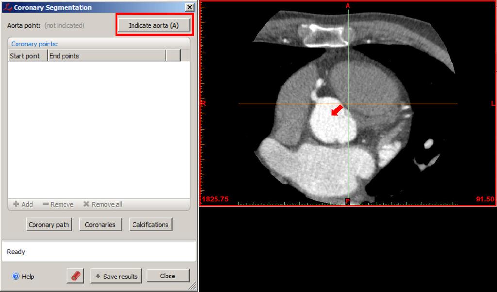 5. In the coronary segmentation window, select the Indicate Aorta button.