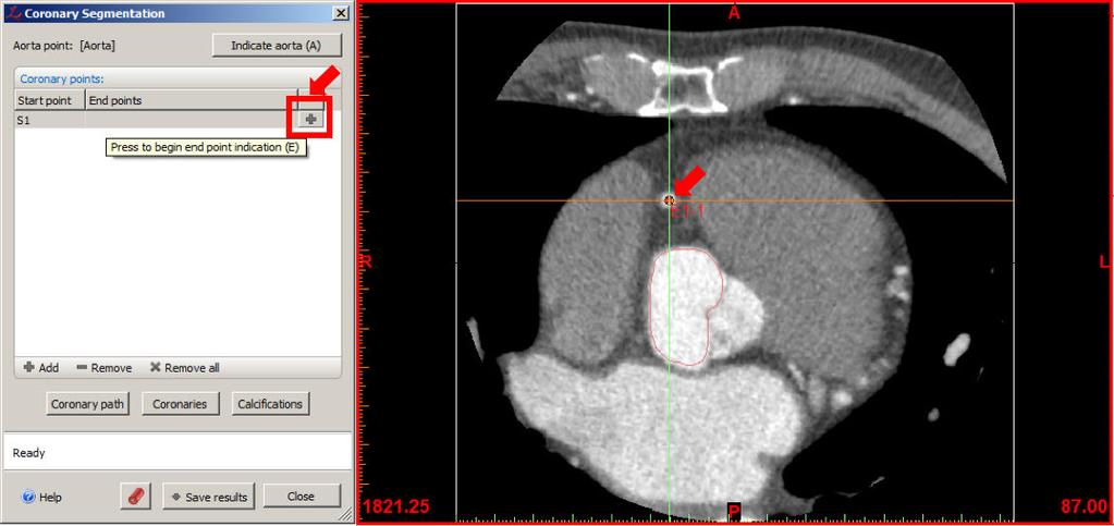 6. In the Coronary Segmentation tool window, click the Add button. In the axial viewport, scroll to slice 91.00 and left click to indicate the location of the right coronary artery starting point.