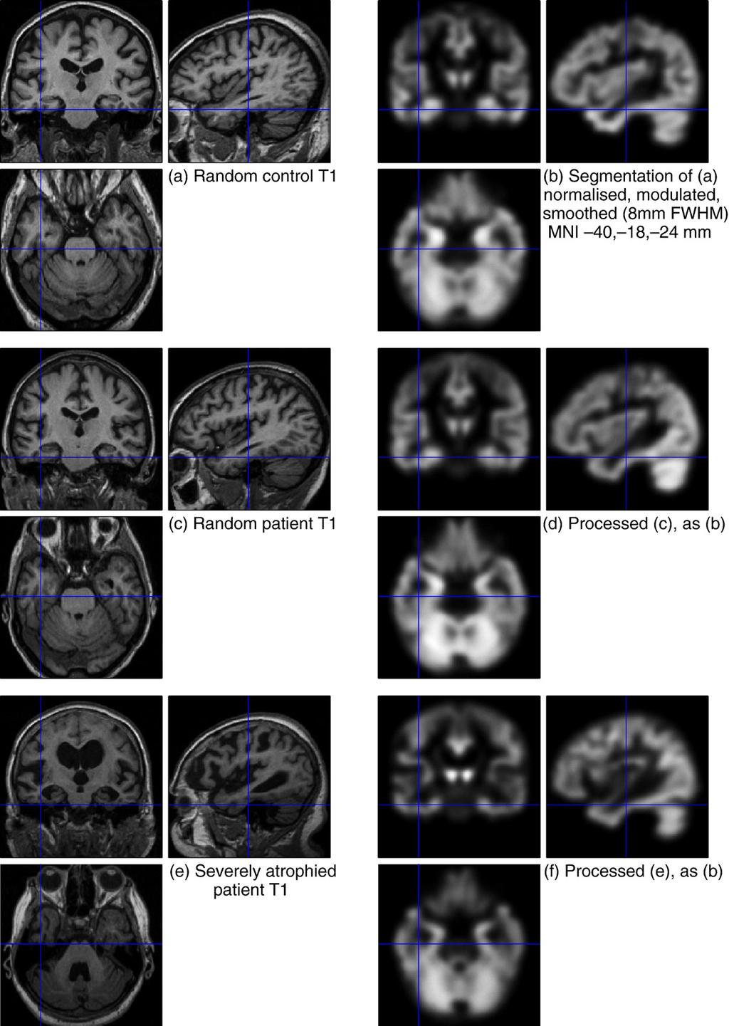 104 G.R. Ridgway et al. / NeuroImage 44 (2009) 99 111 Fig. 4. Example subjects. On the left are the standard clinical T1 images; on the right are their corresponding preprocessed segmentations.