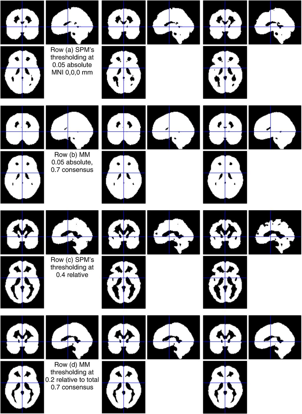 G.R. Ridgway et al. / NeuroImage 44 (2009) 99 111 105 Fig. 5. Masking results for varying method and patient group composition.