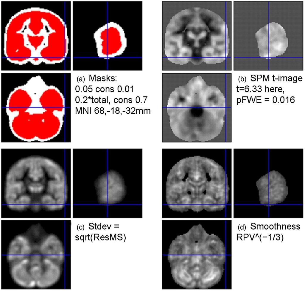 106 G.R. Ridgway et al. / NeuroImage 44 (2009) 99 111 Fig. 6. Masks and GLM results for the comparison of controls and AD patients. (a) shows the mask of Fig.