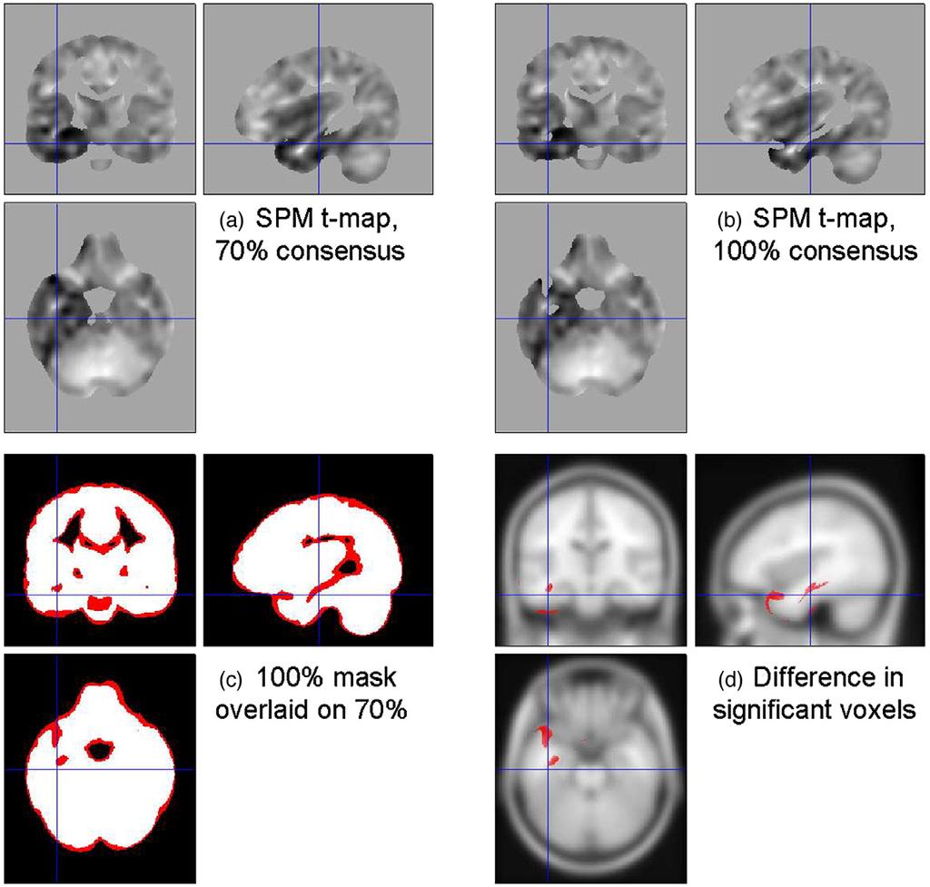 G.R. Ridgway et al. / NeuroImage 44 (2009) 99 111 107 Fig. 7. Masks and regions of significance (pfweb0.05) for the comparison of FTD subjects with controls.
