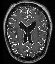 In this figure, the outer cortex is viewed from above; the top of the images corresponds to the anterior of the brain and the bottom to the posterior.