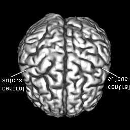 matching of the central sulcus and the interhemispherical fissure.