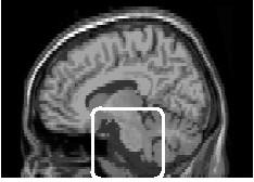 6 Commowick et al. Fig. 2. A slice of the statistical maps obtained in our comparison. The frames show the brainstem and the area in front of it.