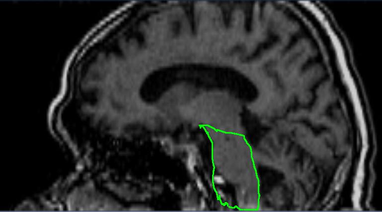 3 that this assumption can result in relatively bad segmentations of the brainstem. In this case, the segmented structure often includes the artery just in front of it.