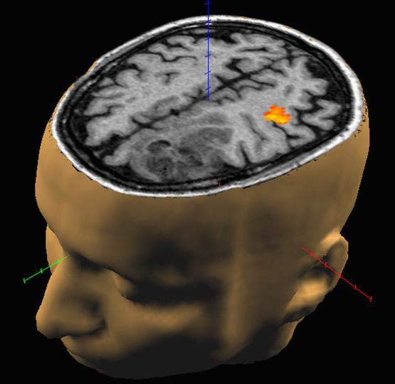 Neuroimaging data feature vector or data point Brain volume Problem:1000 s of features vs.