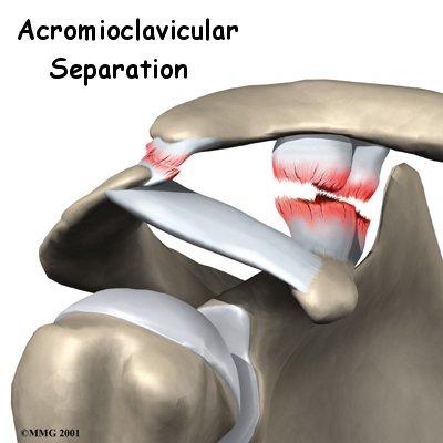 Example: Joints in the Shoulder Complex SC-joint: 3 DoF AC-joint: 3 DoF ST- joint : 4 DoF GH-joint: 3 DoF SC + AC + ST: closed kinematic