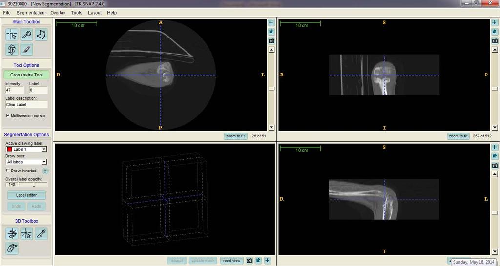 The view in the software is show in fig. 3, where three windows show axial, coronal, and sagittal planes views of the human elbow. The fourth window is the region where 3D model will be developed.