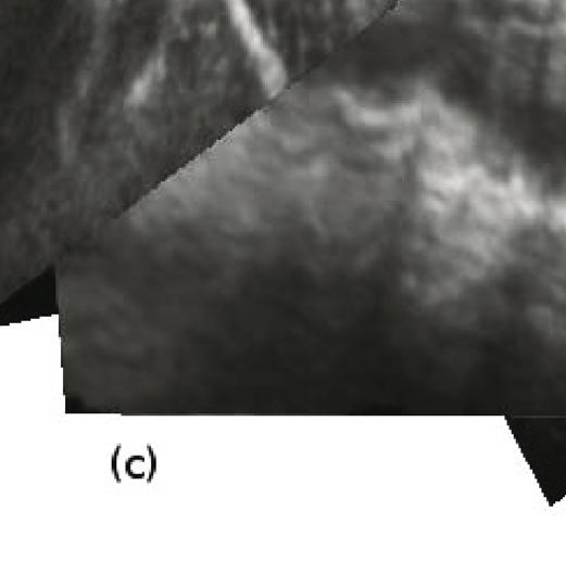 The robustness of automatic rigid CT-Ultrasound registration on such a sequence improved signiﬁcantly when oblique reconstruction planes