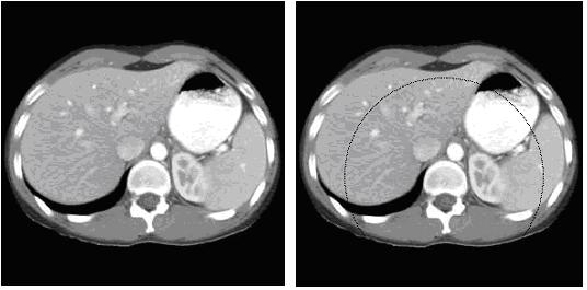 filter Test case 2 is a head CT image of size 209 x 209. The circular ROI is defined by its origin at (-5, 23) with radius 50 pixels.