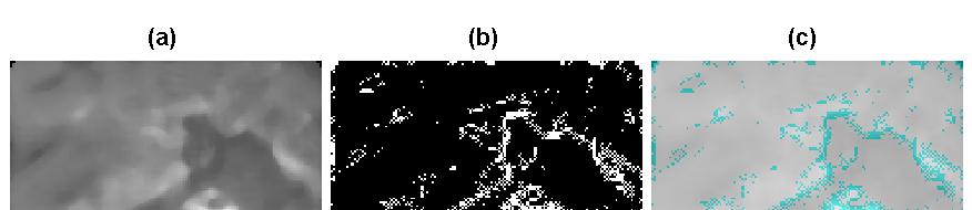 Figure 2: MR image an area with a brain tumor: (a) Original image, (b) Edges found by replacing approximation coefficients by zeros (using Haar wavelet function), (c) Edges projection into the