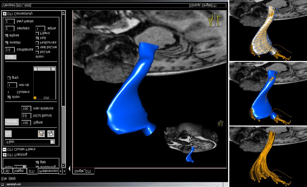 Figure 12: Screenshot of our application (left) showing a case of glioma disease with the tumor emphasized by segmentation.