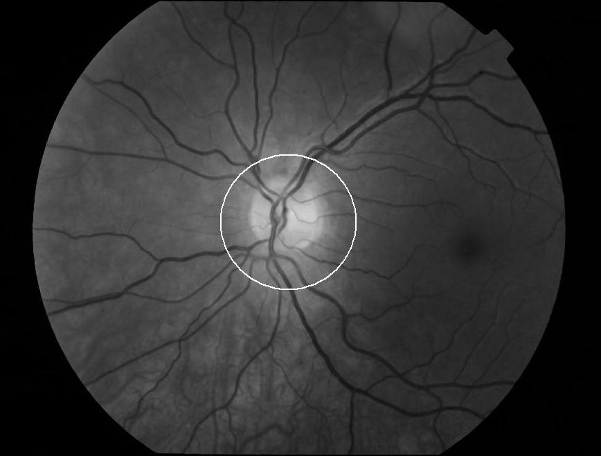 optic disc is shown, a one-dimensional plot