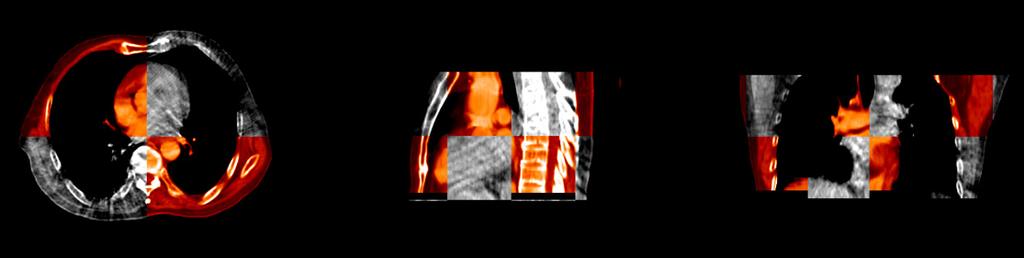 IV. EXPERIMENT AND DISCUSSION CBCT-CBCT, PCT-PCT and PCT-CBCT are regtered respectively for both mono-modality and multi-modality experiments.