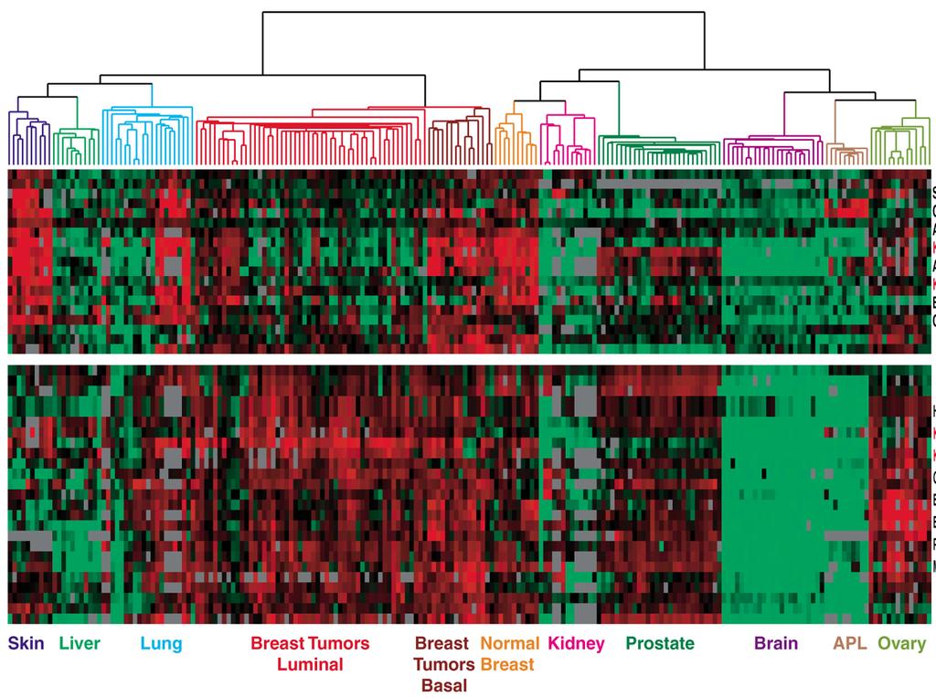 Dendrogram of cancers in human Clustering of genes expressed in malignant tumors by