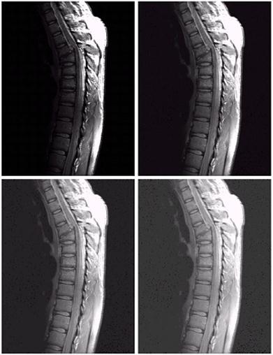 Example: Gamma Transform a. (Upper Left ) MRI Image of an upper thoracic human spine with a fracture dislocation and spinal cord impingement. b.