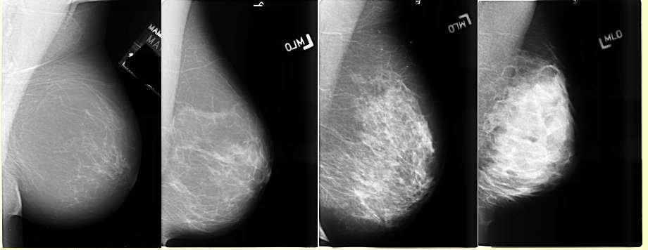 MAMMOGRAM VARIABILITY 1. Breast vary in density, and a range of 1-4 is shown from left to right. 2. From almost entirely fat to extremely dense 3.