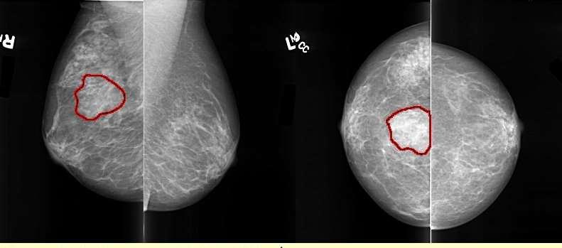 MAMMOGRAM ASYMMETRY 1. The appearance of asymmetries due to positioning and compression during imaging is often the result of superimposition of normal breast structures. 2.