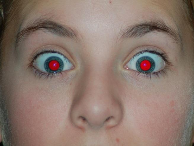 How to Fix Red Eye 1. Open the following image using this URL: https://upload.wikimedia.org/wikipedia/commons/b/b3/boldredeye.jpg 2.
