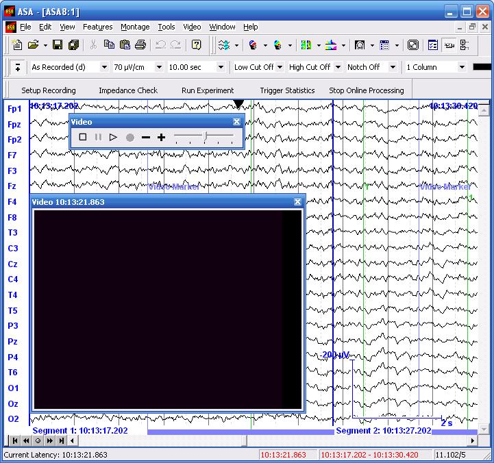 2 Video View ASA makes it possible to record and review video data synchronous with the EEG data from within the same application.