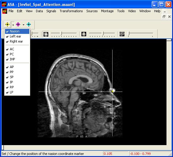 - Slider controls to set upper (255) and lower (0) thresholds of MRI gray values, respectively. These controls are located at the utmost left part of the toolbar.