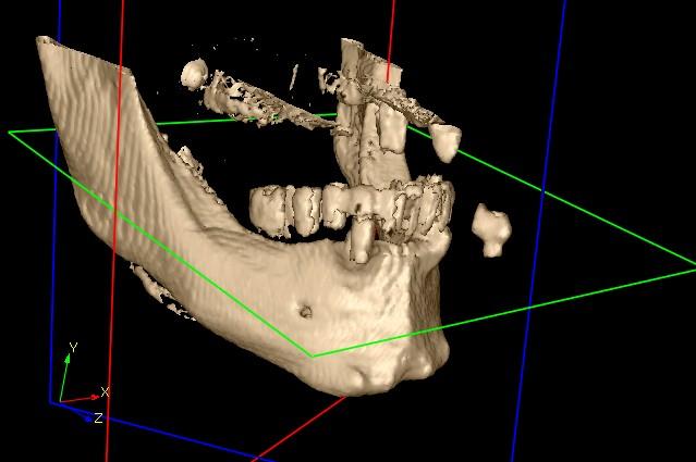 Fully 3D software 3D BONE MODEL The three-dimensional model of the bone is achieved starting from the radiographic dataset and applying a known algorithm of iso-surface extraction called Marching