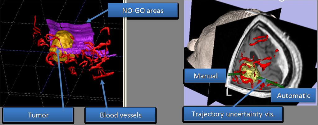 Fig. 1. Screenshot excerpts from our pre-operative planning modules.