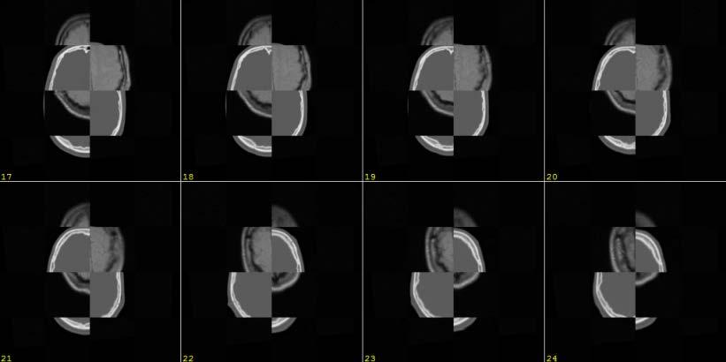 Registration based on Iterative Optimization Checkerboard of the slices before the registration (CT/MRI-PD, brain) F M F M M F M F F M F M M F M F (The checkerboard slice is built by interchanging