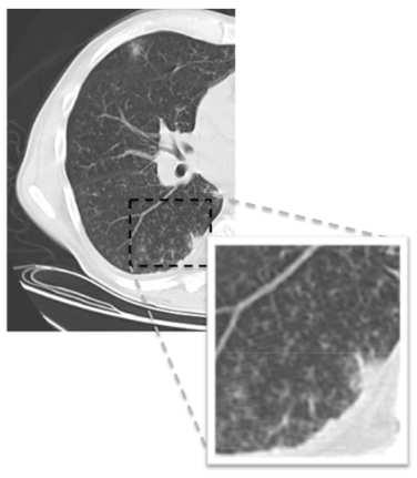 Figure 1. (Left) CT image with a significant amount TIB patterns. (Right) Labelled TIB patterns (blue) in zoomed window on the right lung.