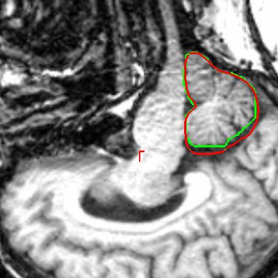 (b) As shown in figure 5.9(a), we have four contours each shown with a different color. Three of these contours are similar and indicate correct segmentation of the cerebellum.