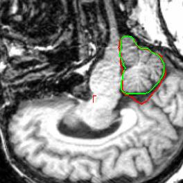 and the brain cortex. The figure 5.13 shows one such patient where the cerebellum contour improves due to less leakage in the cortex, when using several atlases combined with the STAPLE algorithm.