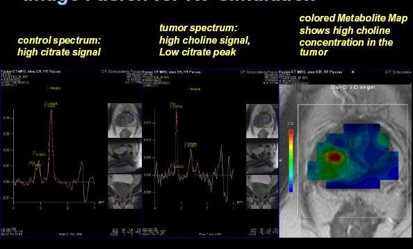 spectroscopy in prostate High concentration of choline inside the prostate = tumor signature Used