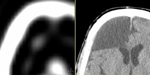delineation on SPECT - CT Example in H&N (Parathyroid Adenoma) : Example in