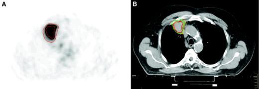PET - CT Example for lung tumors: FDG CT SUV 40% SUV 2.5 D Corrections for the determination of radiotracer concentration (FDG) Images from U.