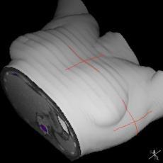 motion artefacts 2D MPR 3D rendering ICRU 50 & 62 GTV : Gross