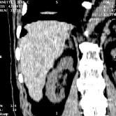 Example of fuzzy separation between right kidney