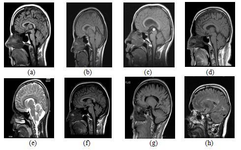 This is found to be a useful tool for segmenting images. 2. Materials and Methods A. Data Set Details For implementation axial and sagittal slices of the MRI brain image were considered.