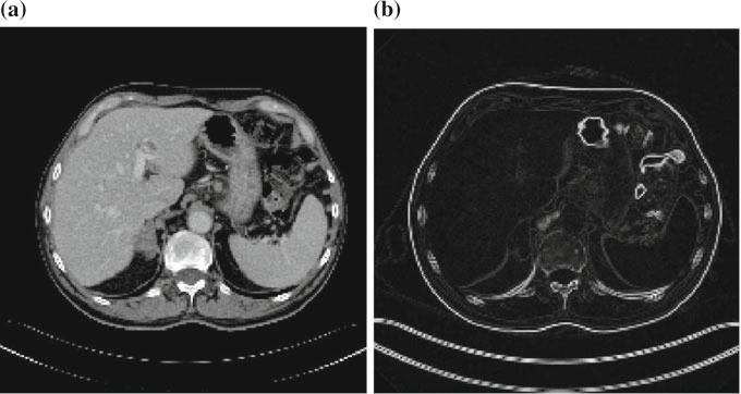 20 M. Galinska and P. Badura Fig. 2 Sample original slice (a) and the gradient image (b) have been initially thresholded in order to obtain the binary volume containing the spleen.
