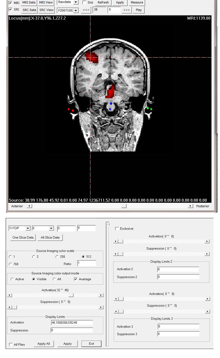 Figure. 10. Volumetric Sources overlapped on MRI (MSI). Each point in source data may have multiple values (shows in the bottom of the images).