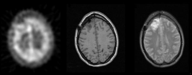 30 Integration of Functional and Anatomical Brain Images: A B C Figure 3.3 Adjacent display with a linked cursor: Corresponding slices from the original images of three modalities.